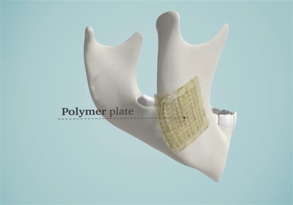 解決醫(yī)生煩惱 3D打印生物陶瓷修復骨骼
生物陶瓷,3D打印生物陶瓷,工業(yè)3d打印機,3D打印機價格,3D打印服務,3D打印技術,中國3d打印技術,上海3D打印,北京3D打印