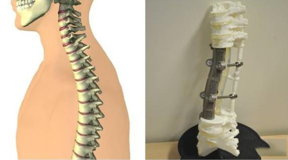 3D打印醫療應用成功案例 北醫三院3D打印定制人工椎體植入術