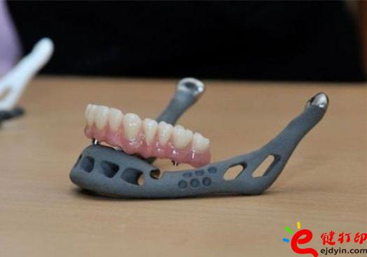 3D打印牙嵌體和牙套哪種更好？3D打印牙齒/隱形牙套/牙冠/模型/成品價格表
