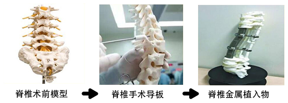 脊椎金屬植入物2